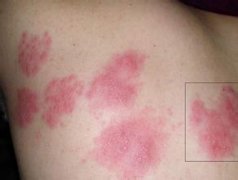 急性荨麻疹会出现哪些症状